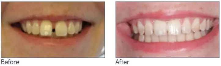 before-after-f