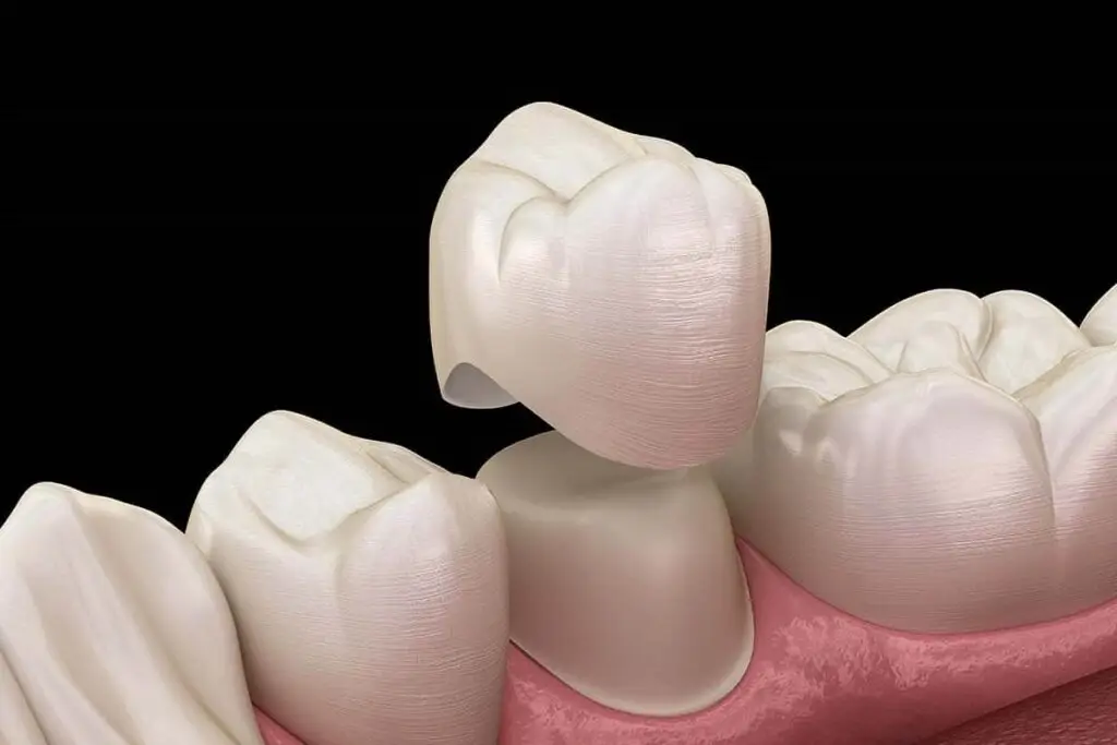 dental crowns at queens gate dental practice