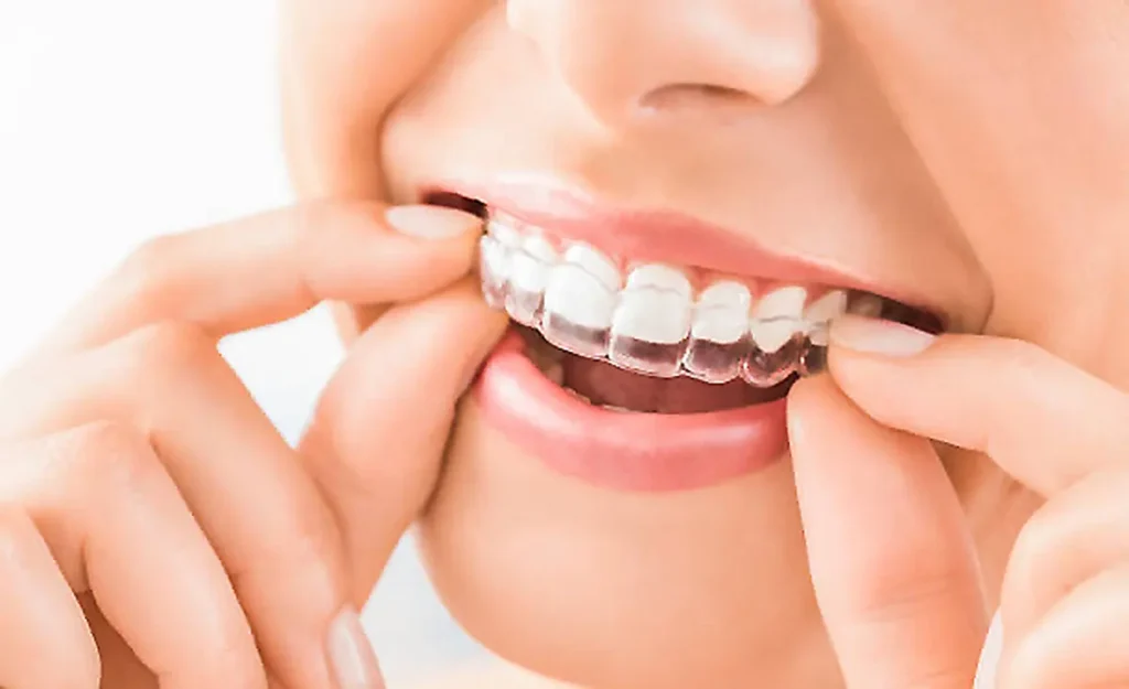 invisibe dental treatment