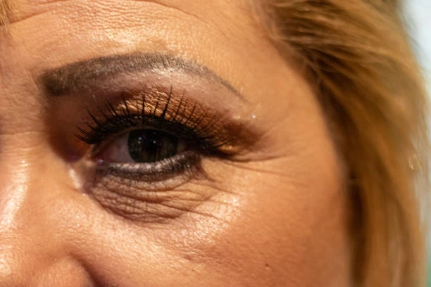 Tear Trough Filler