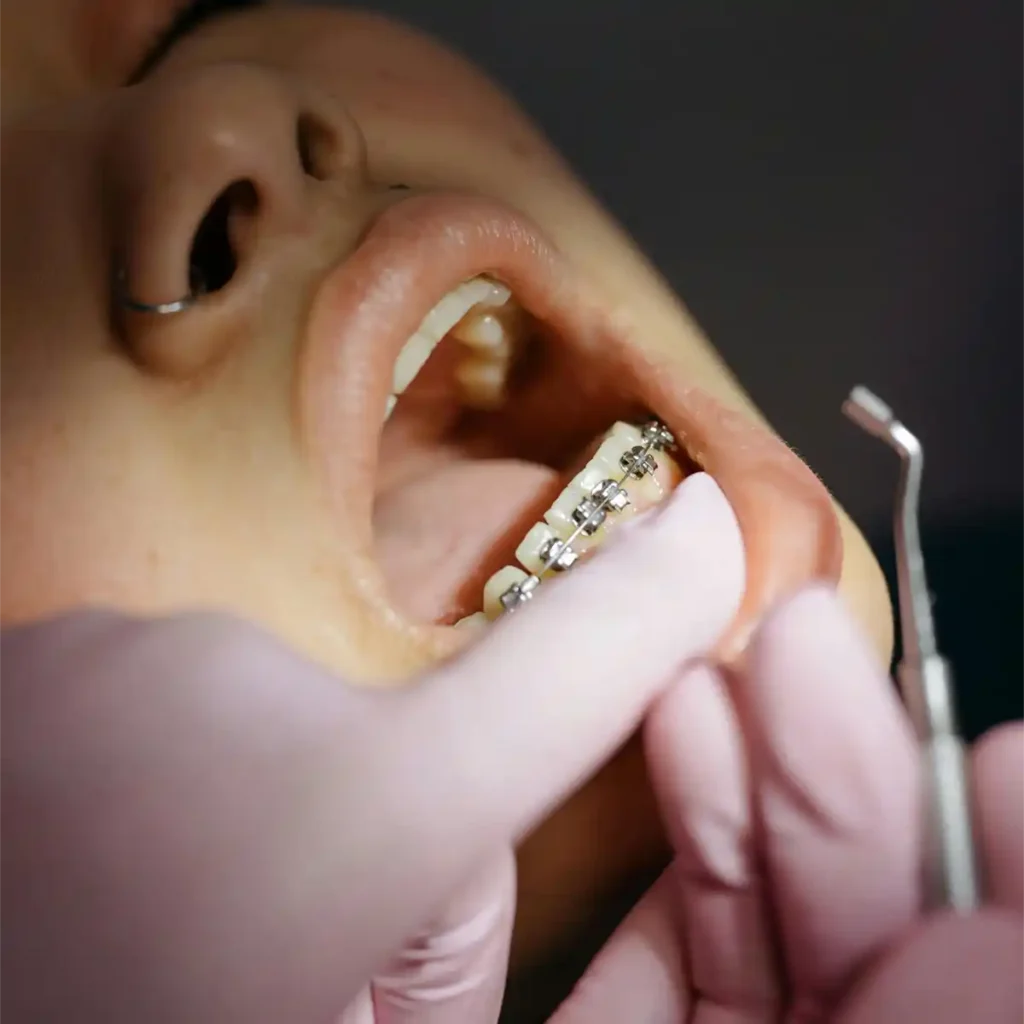 Orthodontist treatment