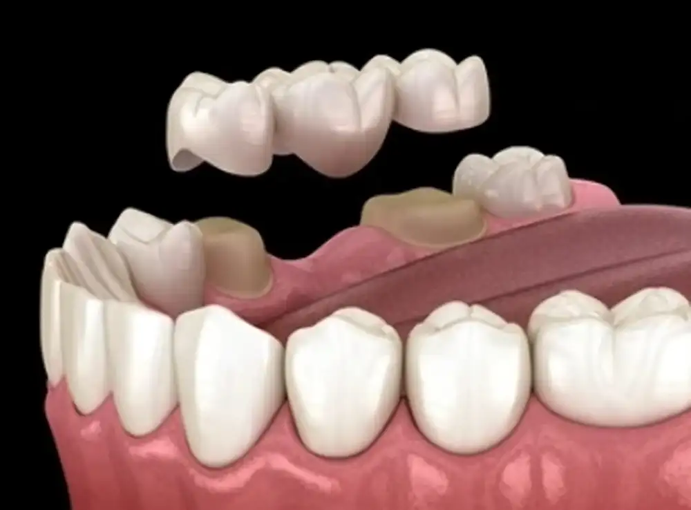 Dental bridges