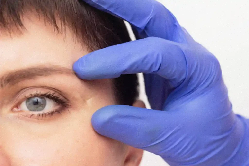 Tear trough filler treatment