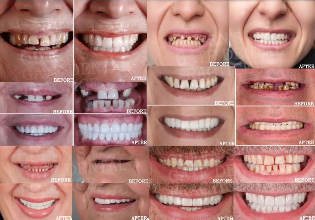 Dental Implants Before After Photos