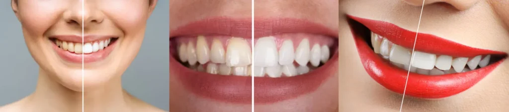 teeth whitening before and after photos