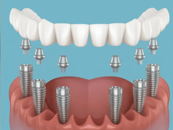 All on 6 Dental Implants diagram