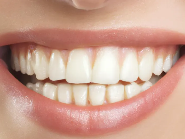 after All on 6 Dental Implants