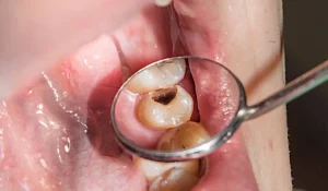 picture showing cavity in patient's mouth