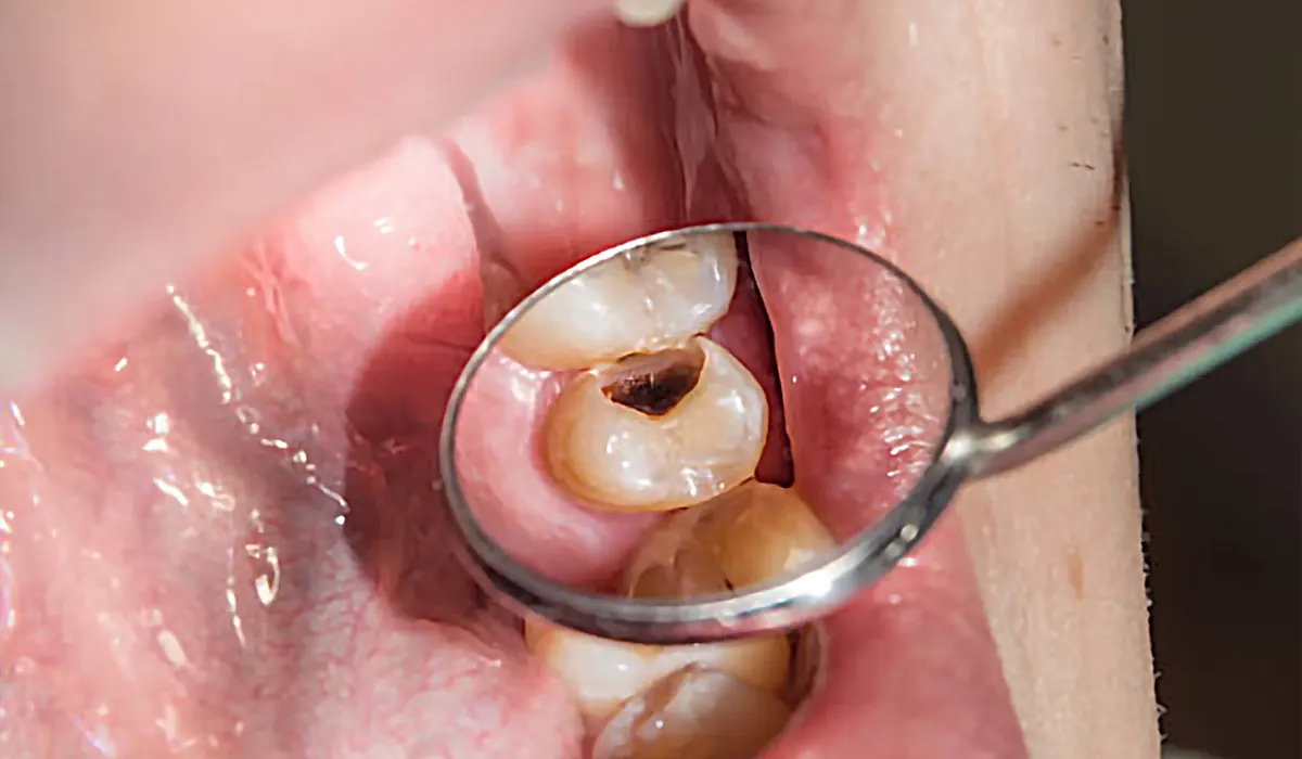 picture showing cavity in patient's mouth