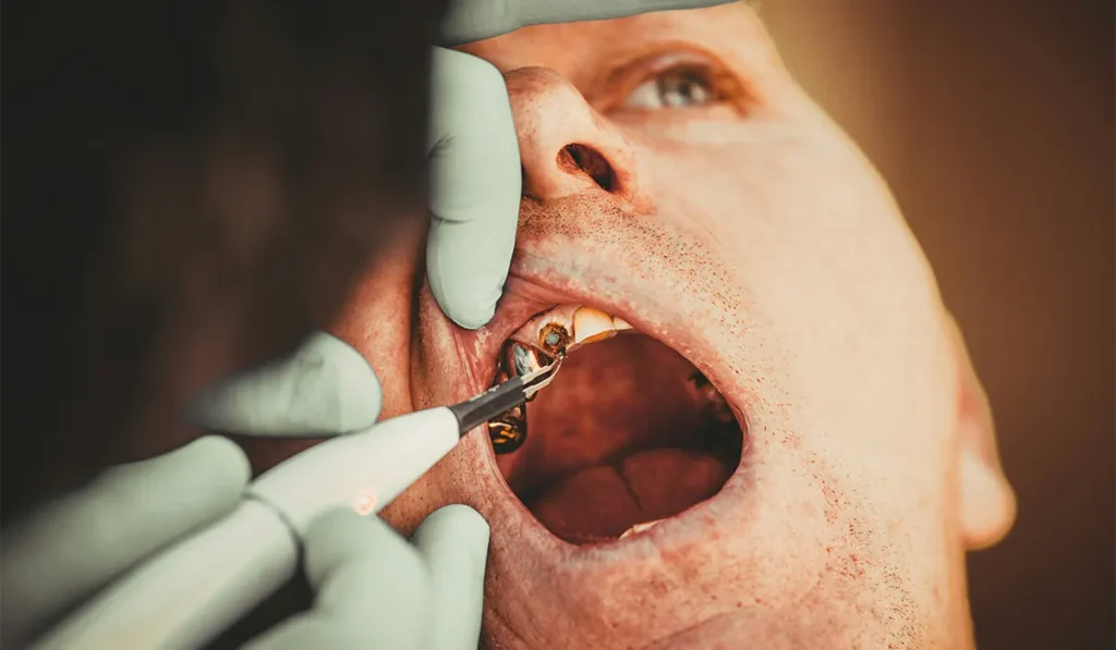 dentist checking up a failed filling